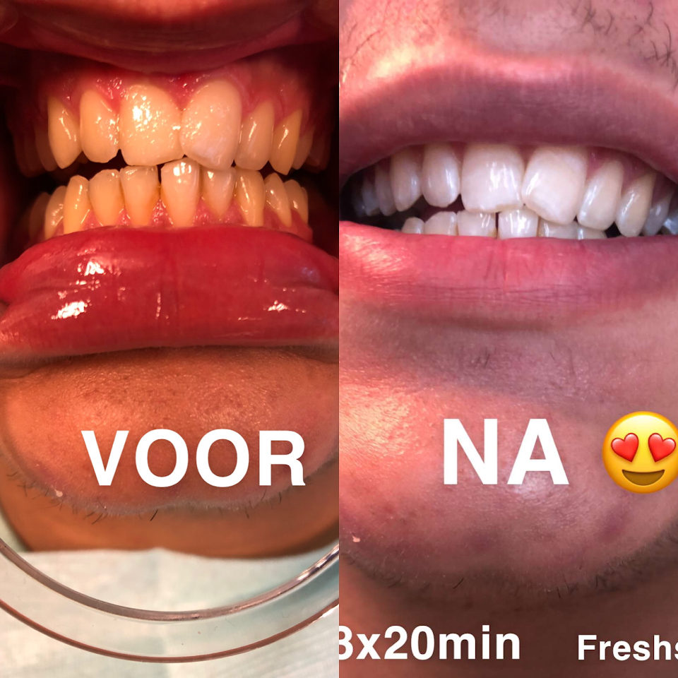 Giotto Dibondon vreugde palm Uniqsmile - Kom je tanden bleken bij ons!